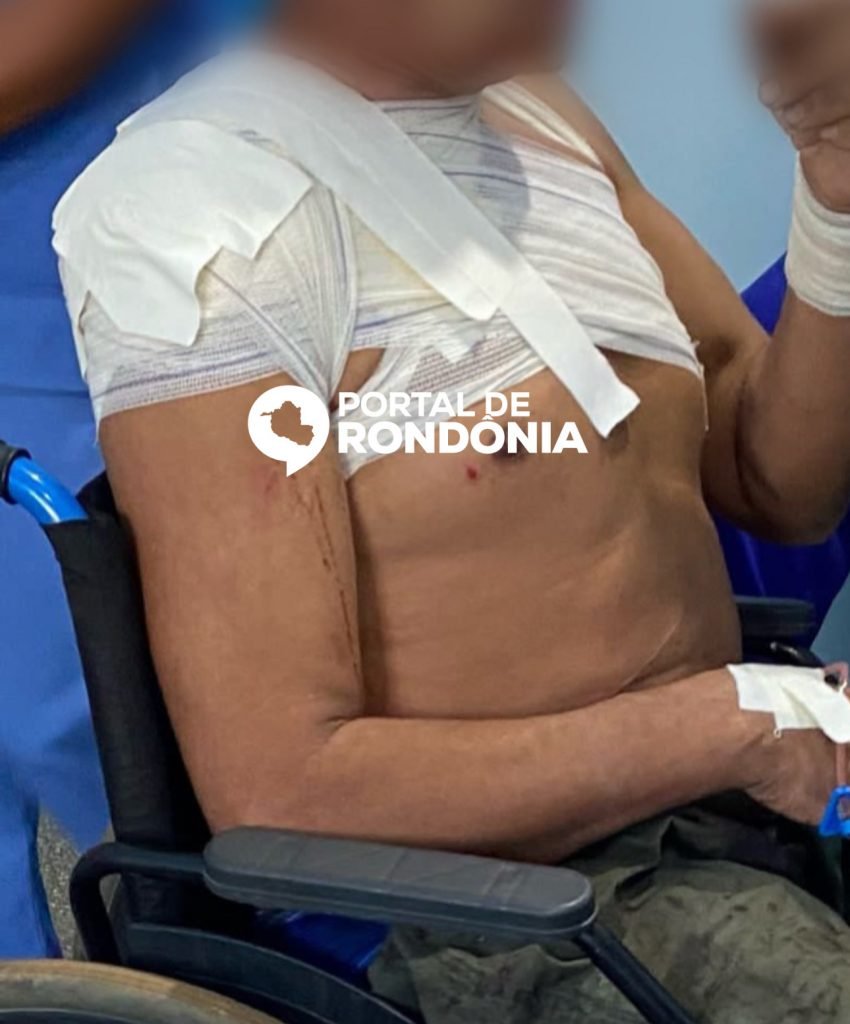 0EBBA0F3-9B52-4ED0-9BD7-0A314FEBF3C3-850x1024 Homem é atacado com tiro de 12 no ombro pelo próprio irmão na zona leste de Porto Velho
